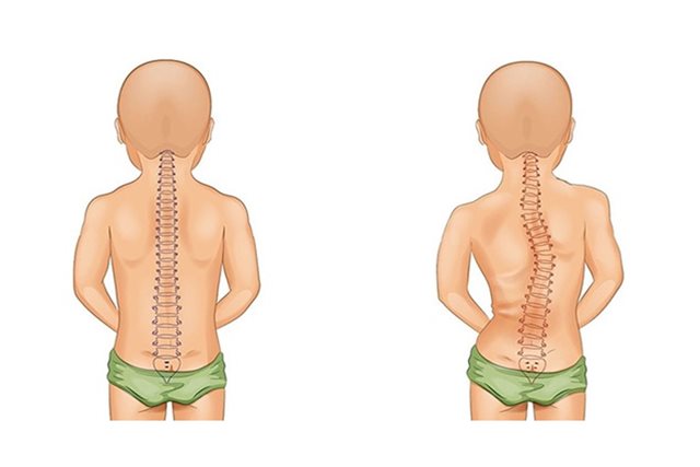 Làm gì khi trẻ gù lưng, cong vẹo cột sống do dùng điện thoại quá nhiều?